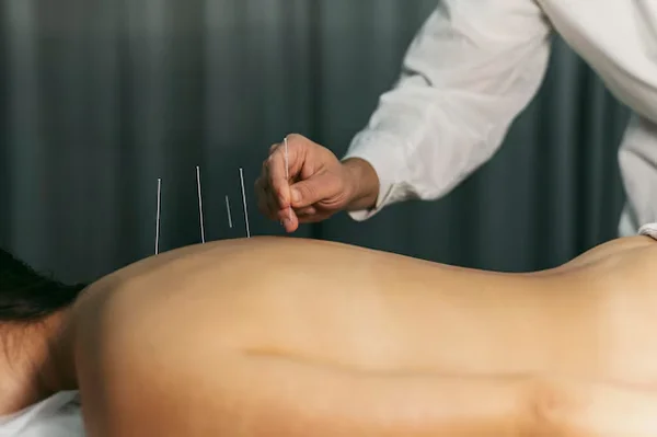 Acupuncture & Acupressure